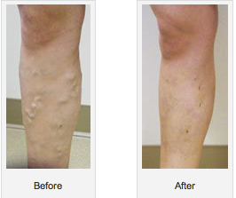 Before-After1 varicose-veins-before-after