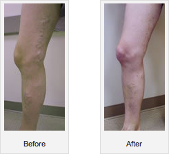 varicose-veins-before-after2