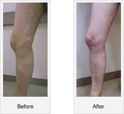 Before-After2 varicose-veins-before-after2