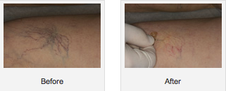 SpiderVeins-Before-After1