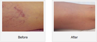 SpiderVeins-Before-After2