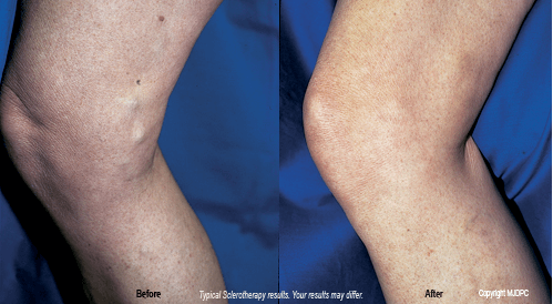 sclerotherapy-beforeafters