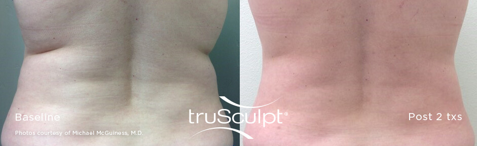 truSculpt_Body_11_web truSculpt-beforeandafter
