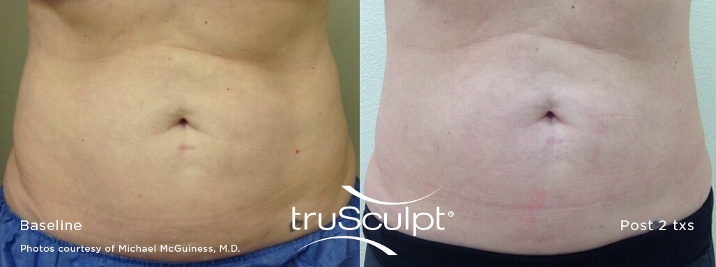 truSculpt_Body_12_web truSculpt-beforeandafter_stomach